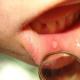 Zapalenie jamy ustnej u dzieci: zdjęcie choroby w jamie ustnej, metody leczenia, zapobieganie i konsekwencje