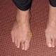 Болюче ущільнення на нозі під шкірою: лікувати чи саме розсмокчеться?